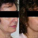 Skin Tightening Before and After Photos in Montvale, NJ, Patient 13196