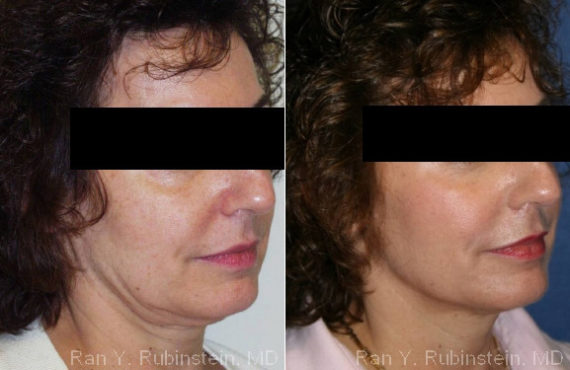 Skin Tightening Before and After Photos in Montvale, NJ, Patient 13196