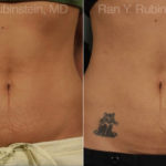 Skin Tightening Before and After Photos in Montvale, NJ, Patient 13207