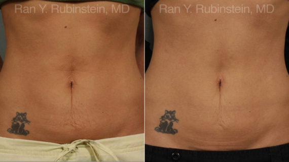 Skin Tightening Before and After Photos in Montvale, NJ, Patient 13207