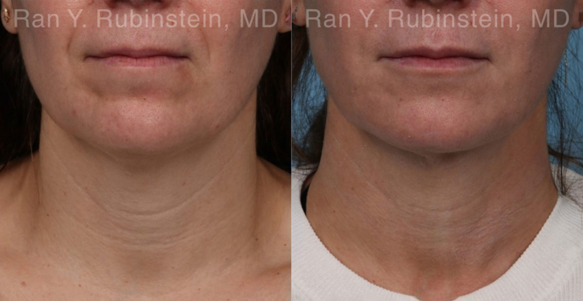 Laser Lift Precision Tx Before and After Photos in Montvale, NJ, Patient 19120