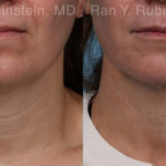 Laser Lift Precision Tx Before and After Photos in Montvale, NJ, Patient 19120