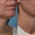 Laser Lift Precision Tx Before and After Photos in Montvale, NJ, Patient 19120