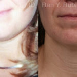 Laser Lift Precision Tx Before and After Photos in Montvale, NJ, Patient 19120