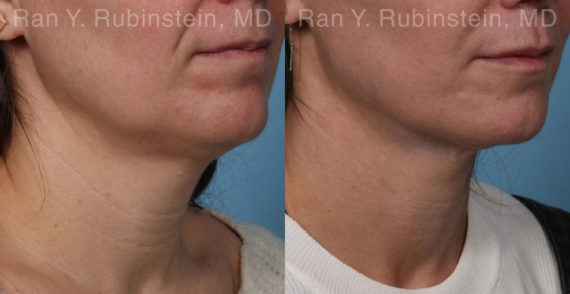 Laser Lift Precision Tx Before and After Photos in Montvale, NJ, Patient 19120