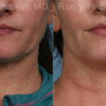 Genius Fractionated RF Before and After Photos in Montvale, NJ, Patient 21952