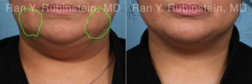 Buccal Fat Removal Before and After Photos in Montvale, NJ, Patient 22162