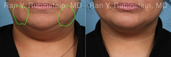 Buccal Fat Removal Before and After Photos in Montvale, NJ, Patient 22162