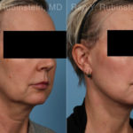 Face lift & Neck lift Before and After Photos in Montvale, NJ, Patient 22249