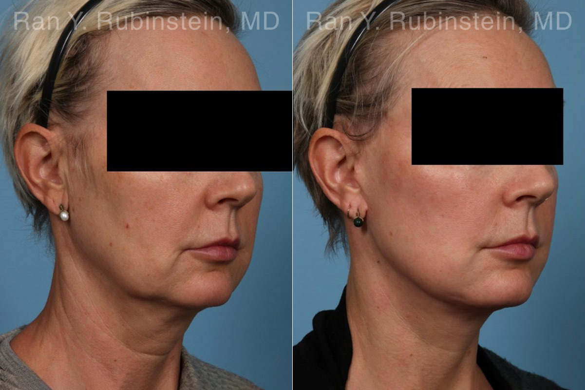 Face lift & Neck lift Before and After Photos in Montvale, NJ, Patient 22249