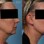 Face lift & Neck lift Before and After Photos in Montvale, NJ, Patient 22249