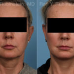 Face lift & Neck lift Before and After Photos in Montvale, NJ, Patient 22249