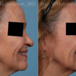 Lip Lift Before and After Photos in Montvale, NJ, Patient 22260
