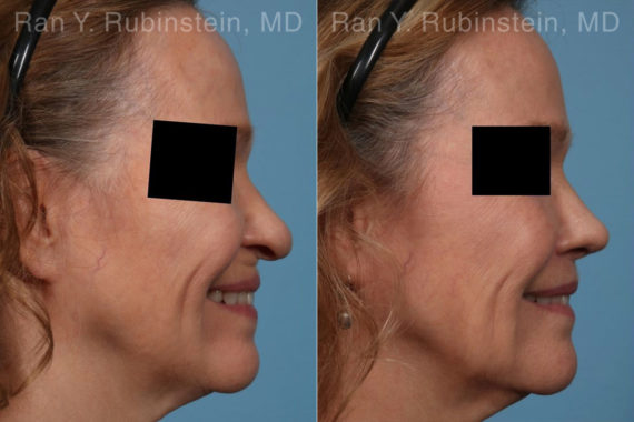 Lip Lift Before and After Photos in Montvale, NJ, Patient 22260