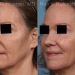 Lip Lift Before and After Photos in Montvale, NJ, Patient 22260