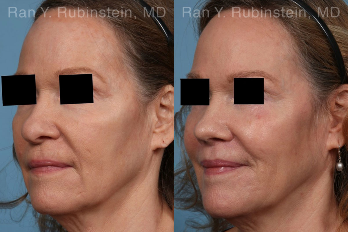 Lip Lift Before and After Photos in Montvale, NJ, Patient 22260