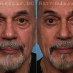 Eyelid Surgery Before and After Photos in Montvale, NJ, Patient 22338
