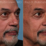 Eyelid Surgery Before and After Photos in Montvale, NJ, Patient 22338