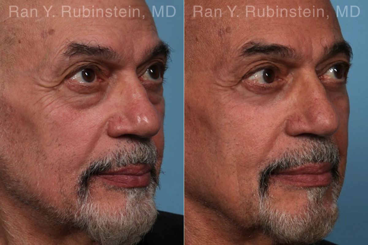 Eyelid Surgery Before and After Photos in Montvale, NJ, Patient 22338