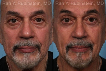 Eyelid Surgery Before and After Photos in Montvale, NJ, Patient 22338