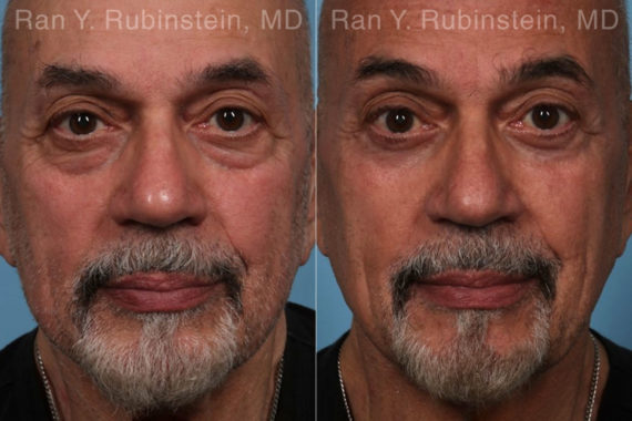 Eyelid Surgery Before and After Photos in Montvale, NJ, Patient 22338