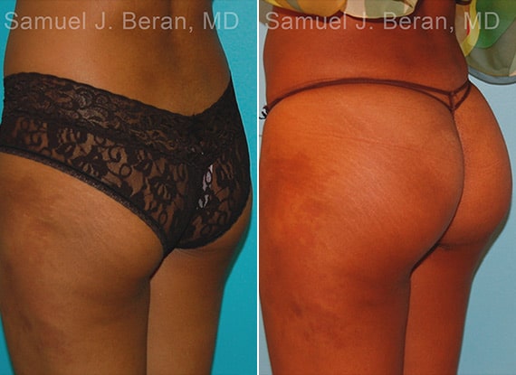 Brazilian Butt Lift Before & After Photos