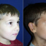 Otoplasty Before and After Photos in Montvale, NJ, Patient 12956