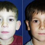 Otoplasty Before and After Photos in Montvale, NJ, Patient 12956