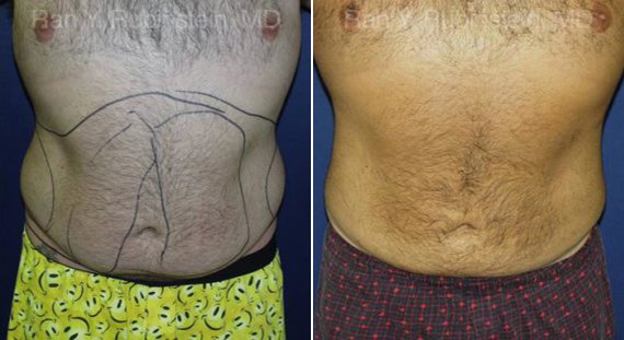 Smart Lipo Tripex Body Before & After Photos