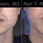 Chin Augmentation Before and After Photos in Montvale, NJ, Patient 23272