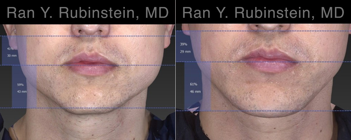 Chin Augmentation Before and After Photos in Montvale, NJ, Patient 23272