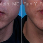 Chin Augmentation Before and After Photos in Montvale, NJ, Patient 23272