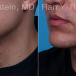 Chin Augmentation Before and After Photos in Montvale, NJ, Patient 23272