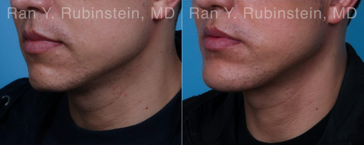Chin Augmentation Before and After Photos in Montvale, NJ, Patient 23272