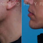 Chin Augmentation Before and After Photos in Montvale, NJ, Patient 23272