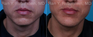 Chin Augmentation Before and After Photos in Montvale, NJ, Patient 23272