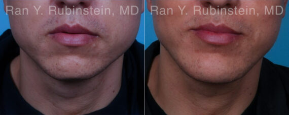 Chin Augmentation Before and After Photos in Montvale, NJ, Patient 23272