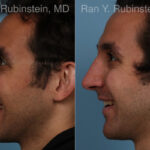 Rhinoplasty Before and After Photos in Montvale, NJ, Patient 23300