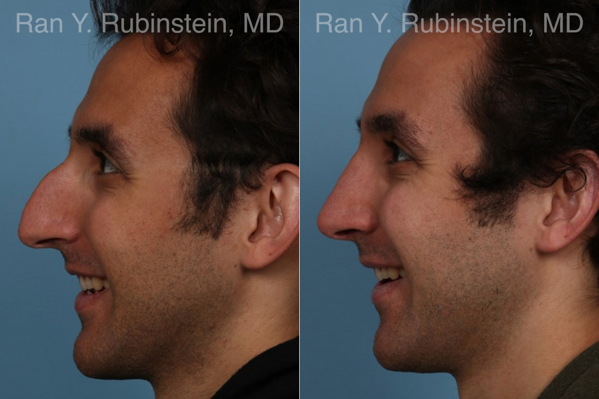 Rhinoplasty Before and After Photos in Montvale, NJ, Patient 23300