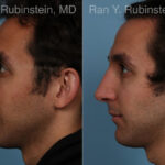 Rhinoplasty Before and After Photos in Montvale, NJ, Patient 23300