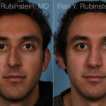 Rhinoplasty Before and After Photos in Montvale, NJ, Patient 23300