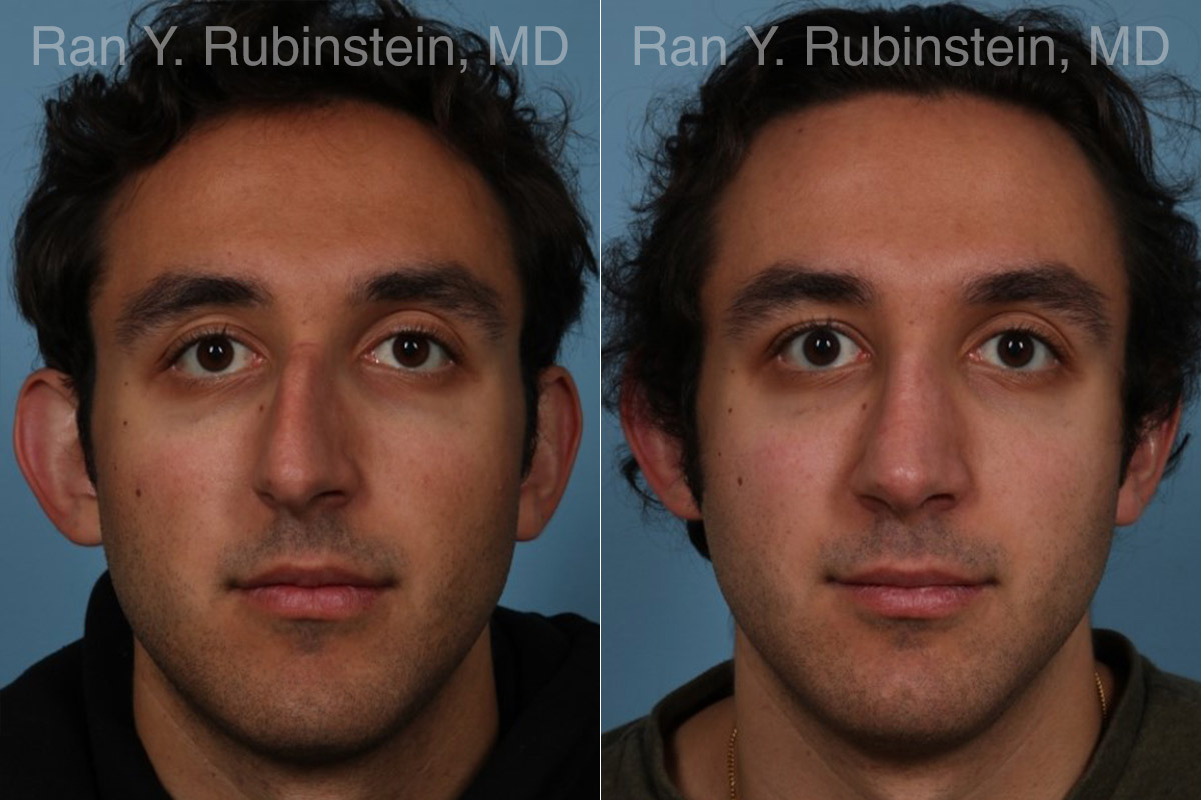 Rhinoplasty Before and After Photos in Montvale, NJ, Patient 23300