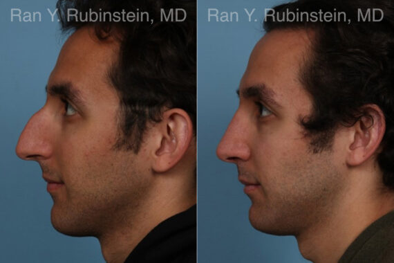 Rhinoplasty Before and After Photos in Montvale, NJ, Patient 23300