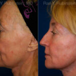 Jawline Filler Before and After Photos in Montvale, NJ, Patient 12779