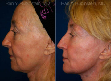 Jawline Filler Before and After Photos in Montvale, NJ, Patient 12779