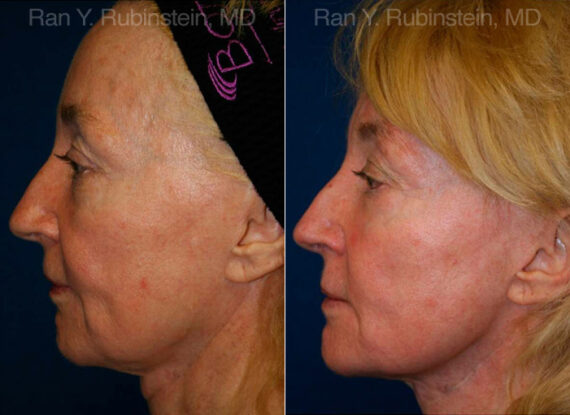 Jawline Filler Before and After Photos in Montvale, NJ, Patient 12779
