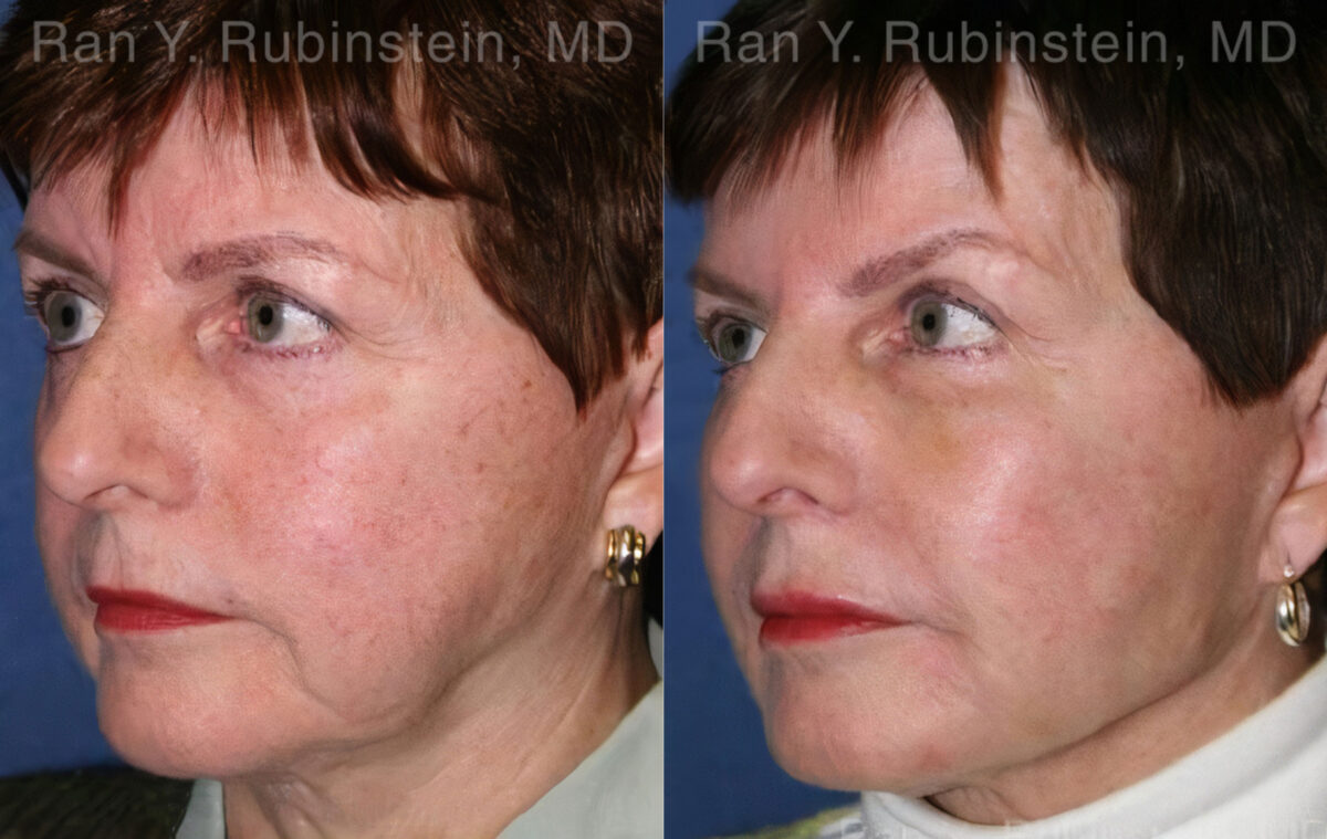 Dermal Fillers Before and After Photos in Montvale, NJ, Patient 12799