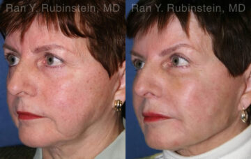 Dermal Fillers Before and After Photos in Montvale, NJ, Patient 12799