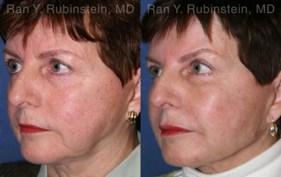Dermal Fillers Before and After Photos in Montvale, NJ, Patient 12799