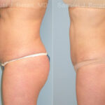Liposuction Before and After Photos in Montvale, NJ, Patient 12898